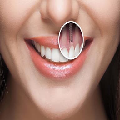 Dental Implant