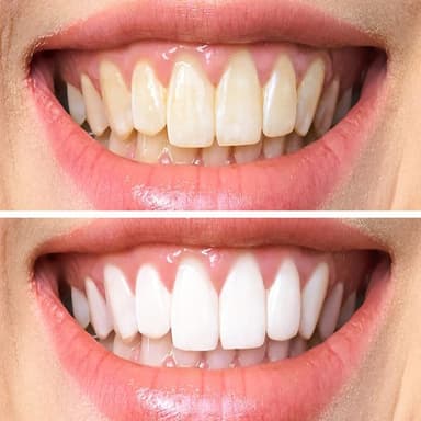 Teeth bleaching